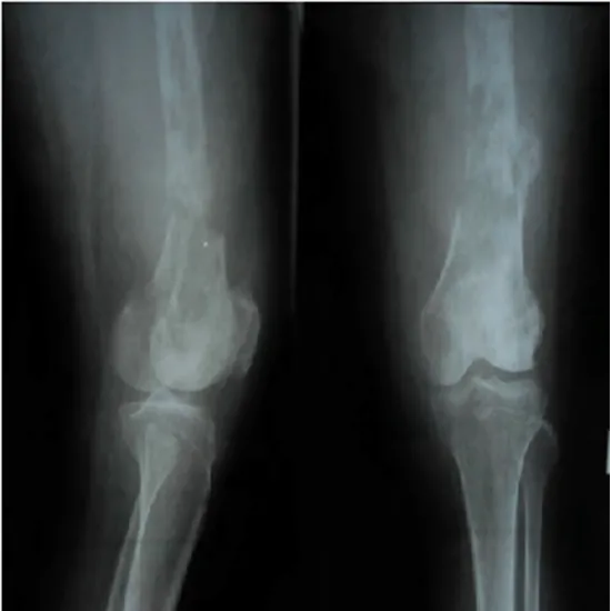 X-Ray Both Thigh AP View